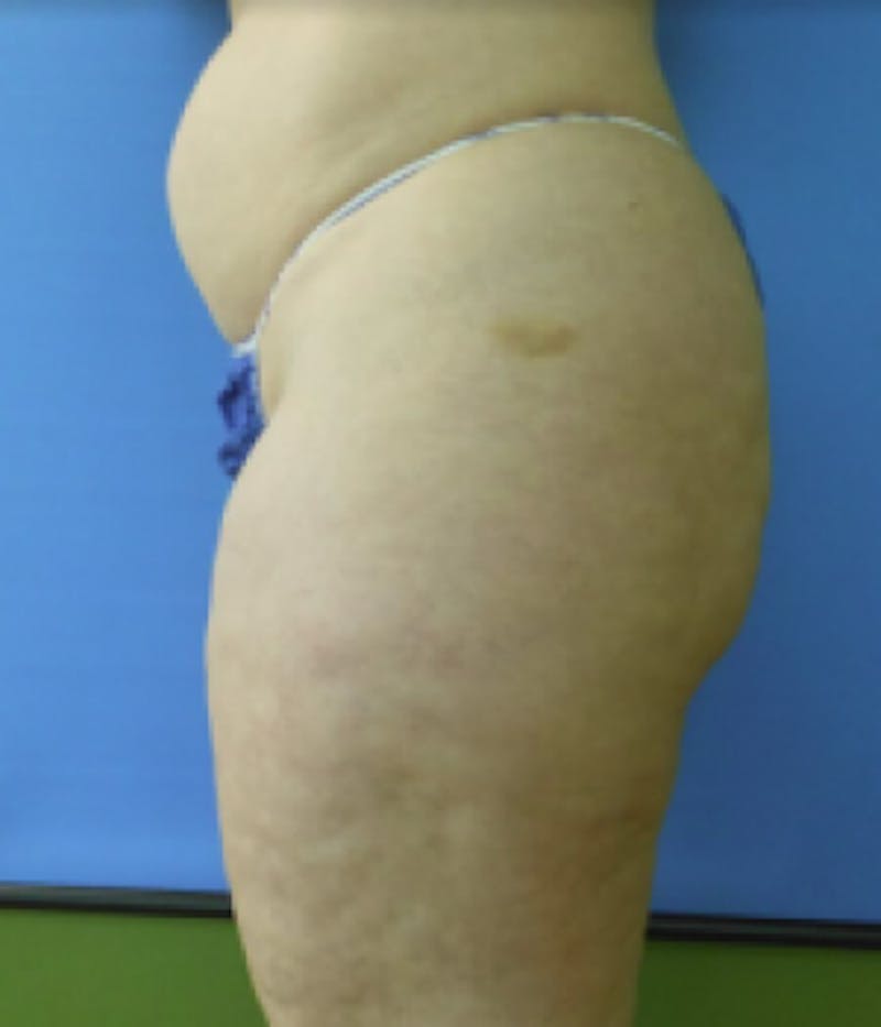 Inner Thigh Before & After Gallery - Patient 57609351 - Image 3