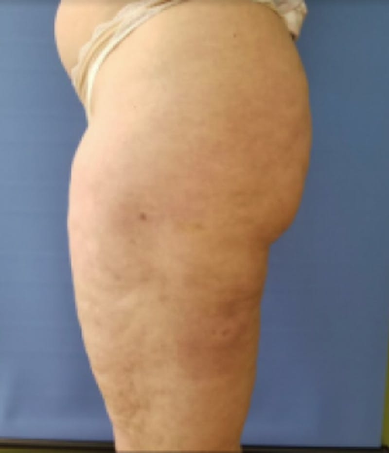 Inner Thigh Before & After Gallery - Patient 57609351 - Image 4