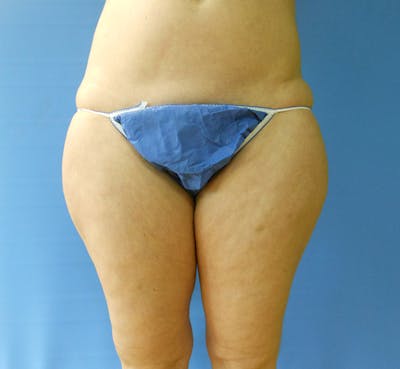 Inner Thigh Before & After Gallery - Patient 57609352 - Image 1