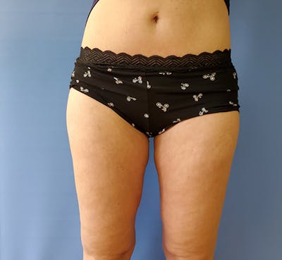 Inner Thigh Before & After Gallery - Patient 57609352 - Image 2