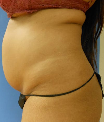 Abdomen Before & After Gallery - Patient 95447444 - Image 1