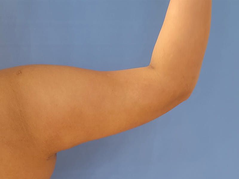 Arms Before & After Gallery - Patient 95447446 - Image 2