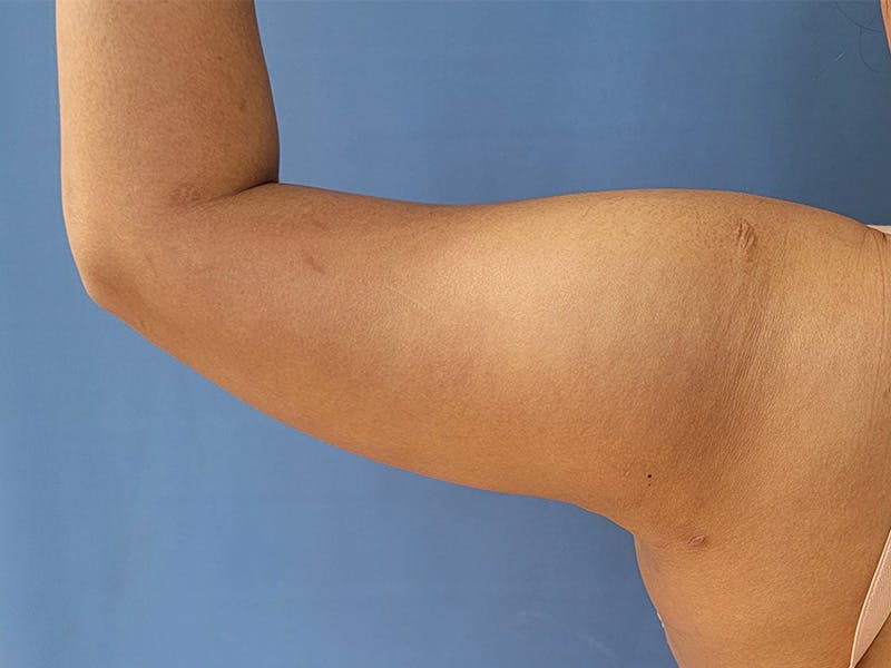 Arms Before & After Gallery - Patient 95447446 - Image 4