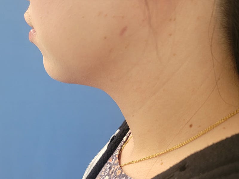 Neck Before & After Gallery - Patient 133475176 - Image 2