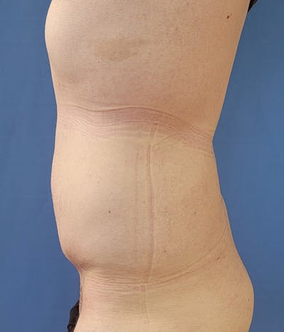 Abdomen Before & After Gallery - Patient 133503125 - Image 2