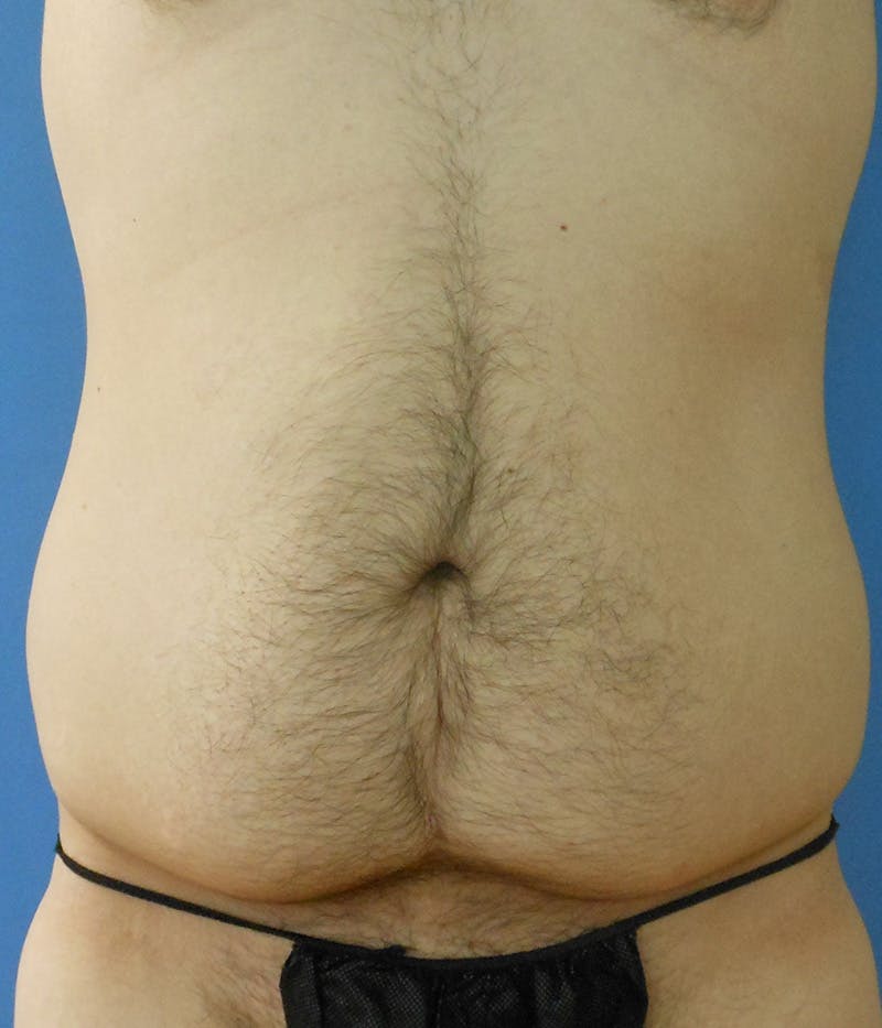 Abdomen Before & After Gallery - Patient 133503125 - Image 3
