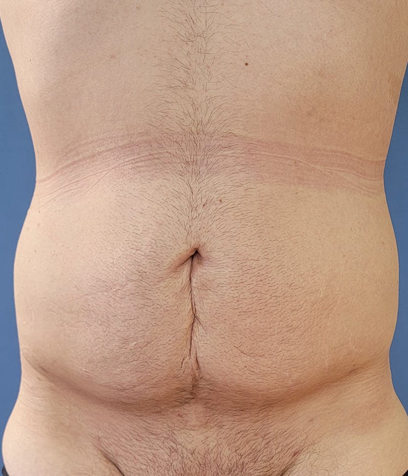 Abdomen Before & After Gallery - Patient 133503125 - Image 4