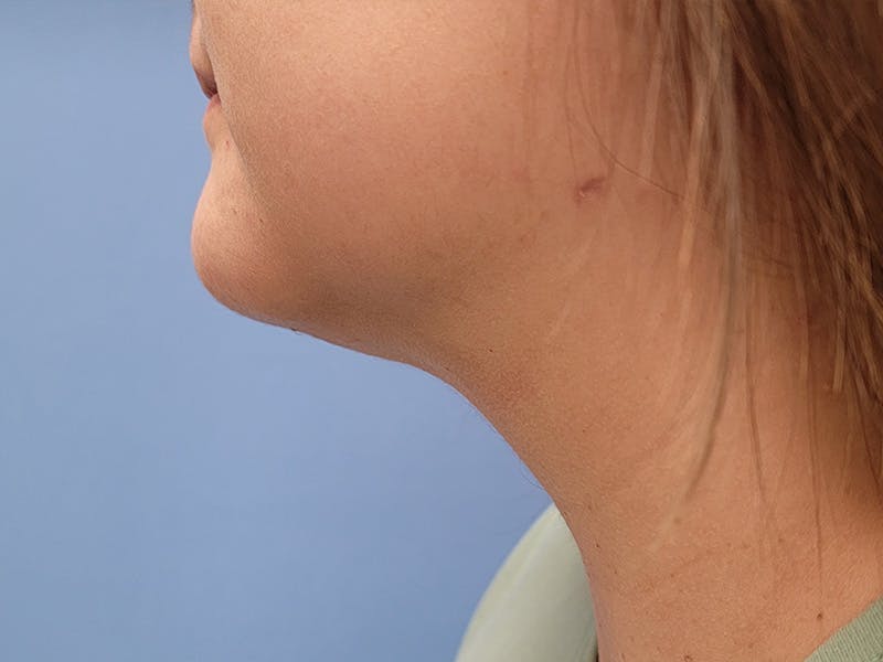 Neck Before & After Gallery - Patient 134896905 - Image 2