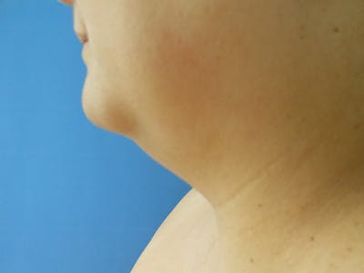 Neck Before & After Gallery - Patient 134896905 - Image 1