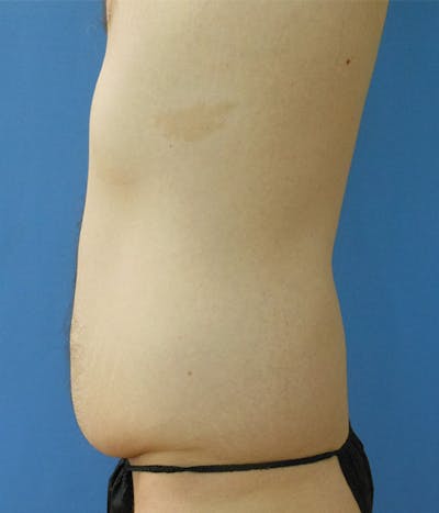 Flanks Before & After Gallery - Patient 151351627 - Image 1