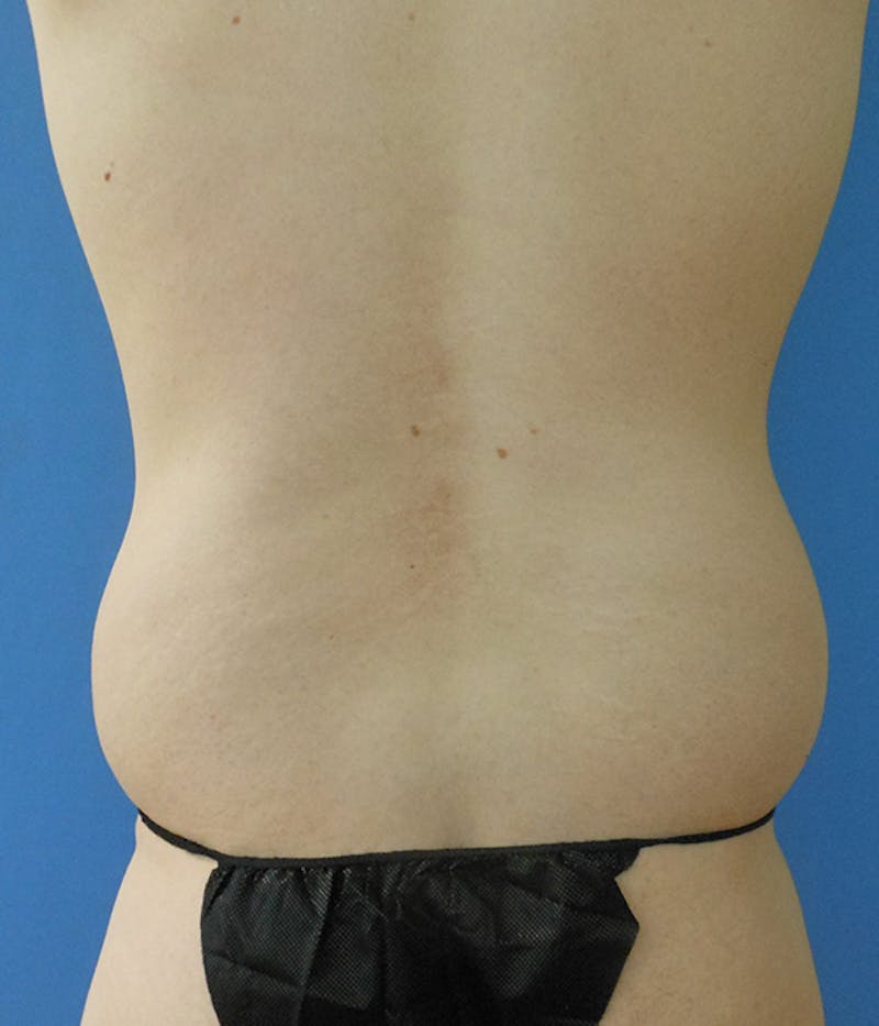 Flanks Before & After Gallery - Patient 151351627 - Image 3