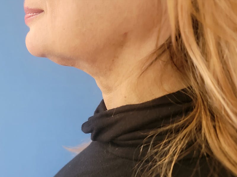 Neck Before & After Gallery - Patient 160772412 - Image 2