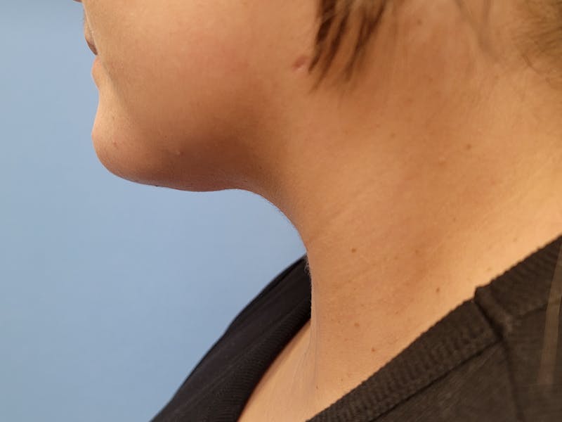 Neck Before & After Gallery - Patient 134896905 - Image 2