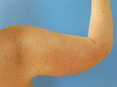 Arms Before & After Gallery - Patient 163740622 - Image 1