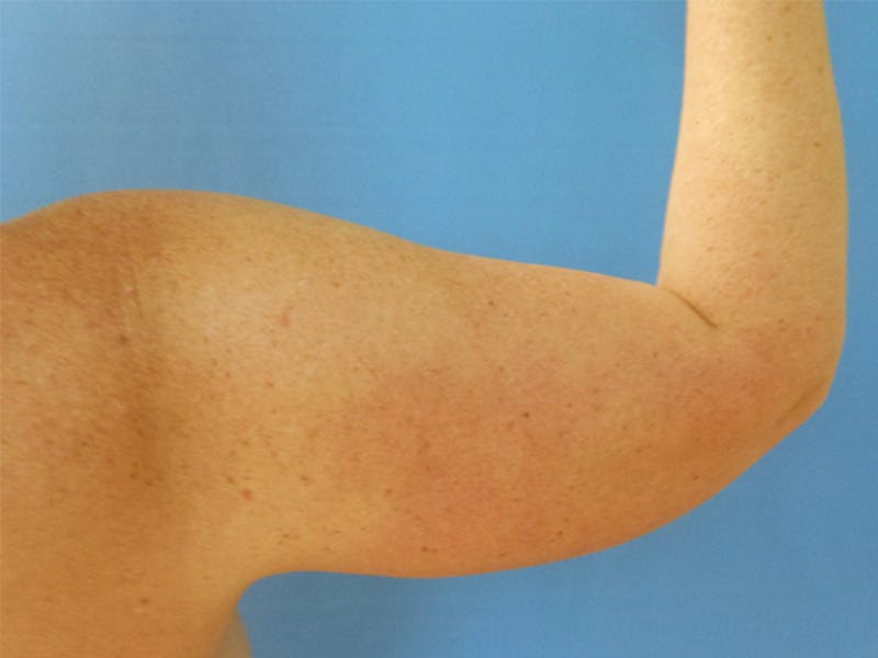 Arms Before & After Gallery - Patient 163740622 - Image 1