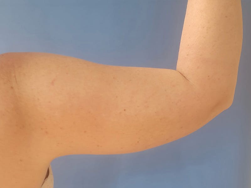 Arms Before & After Gallery - Patient 163740622 - Image 2