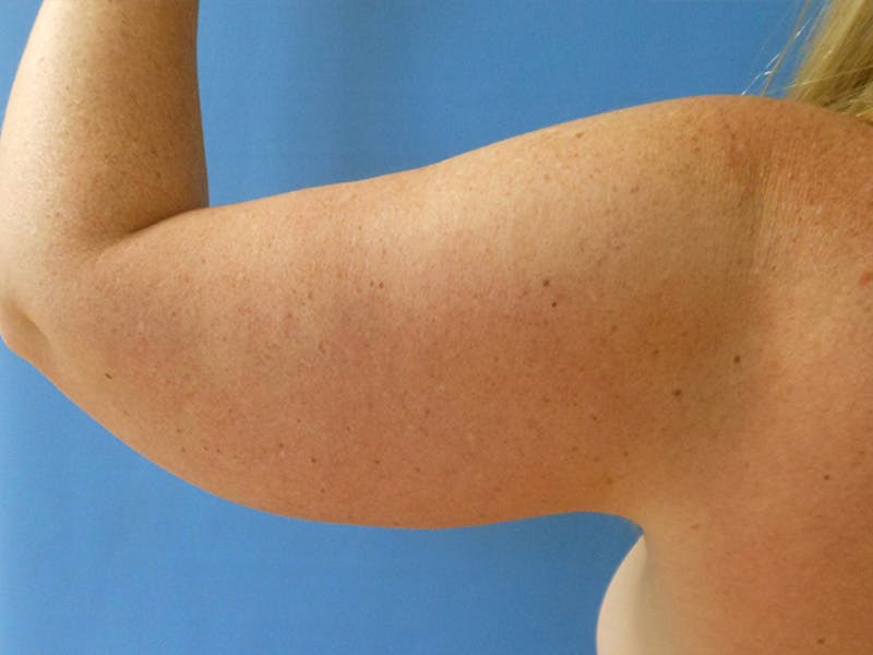 Arms Before & After Gallery - Patient 163740622 - Image 3