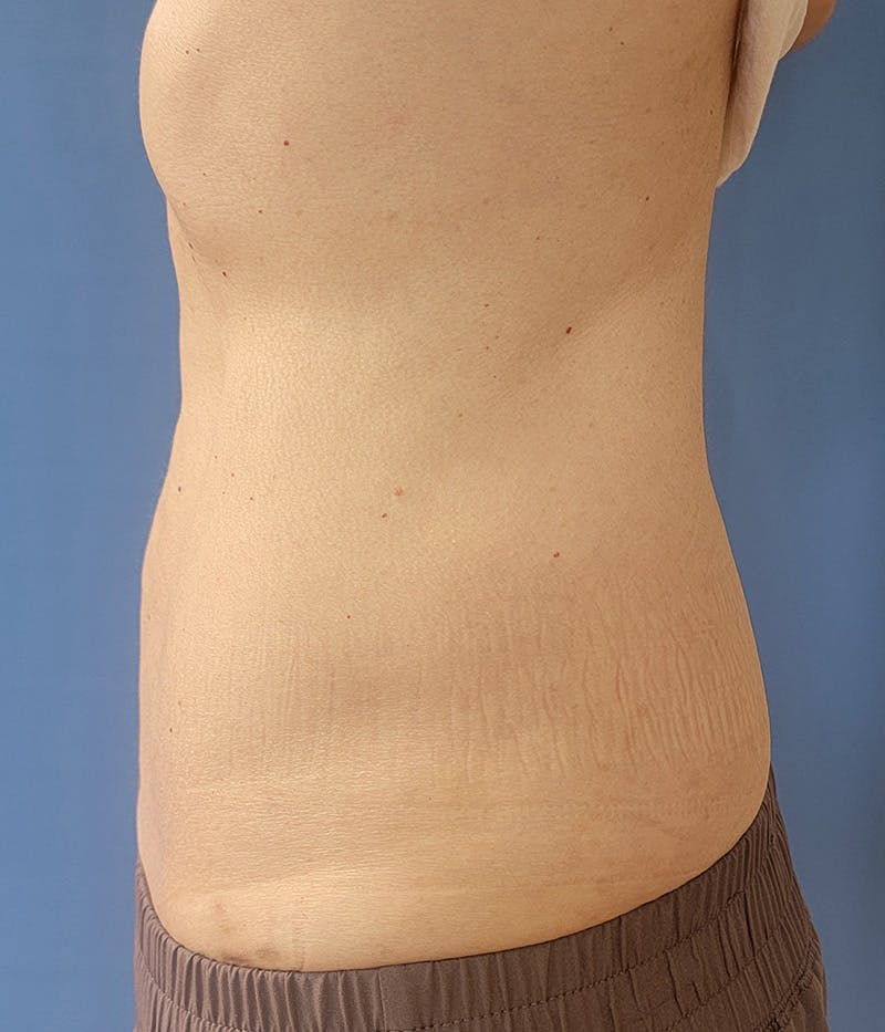 Abdomen Before & After Gallery - Patient 185847523 - Image 2