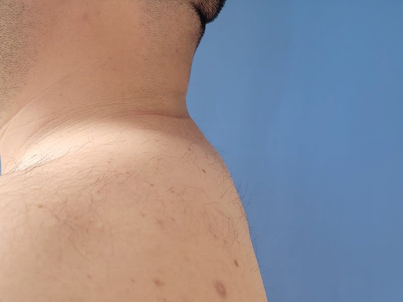 Buffalo Hump Before & After Gallery - Patient 198444871 - Image 2