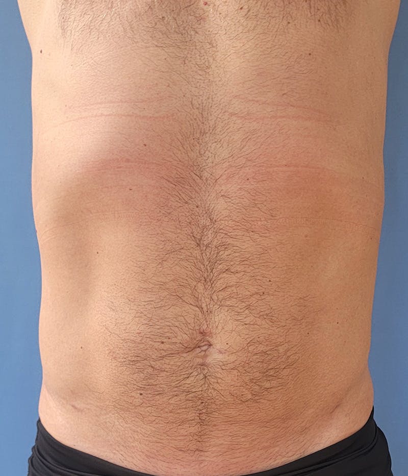 Abdomen Before & After Gallery - Patient 150344 - Image 4