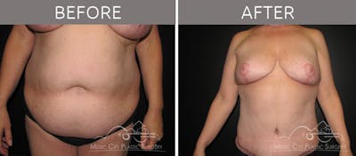 Abdominoplasty Before & After Gallery - Patient 90704924 - Image 3