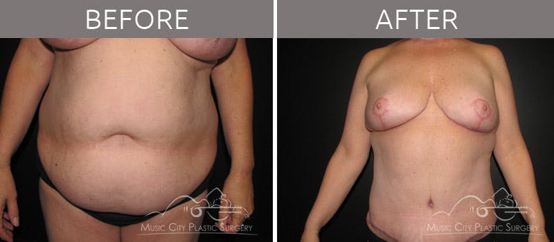 Abdominoplasty Before & After Gallery - Patient 90704924 - Image 2