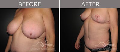 Abdominoplasty Before & After Gallery - Patient 90704924 - Image 2