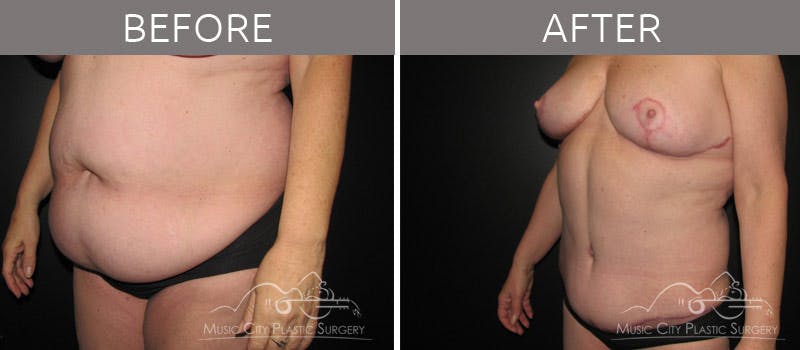 Abdominoplasty Before & After Gallery - Patient 90704924 - Image 4