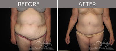 Abdominoplasty Before & After Gallery - Patient 90704927 - Image 1