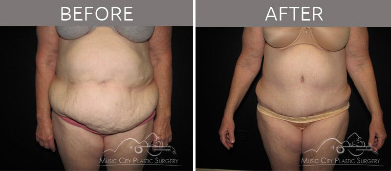 Abdominoplasty Before & After Gallery - Patient 90704927 - Image 1