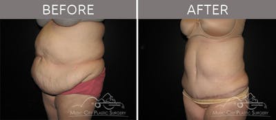 Abdominoplasty Before & After Gallery - Patient 90704927 - Image 2
