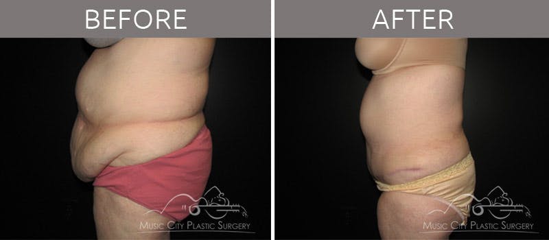 Abdominoplasty Before & After Gallery - Patient 90704927 - Image 3