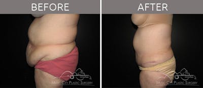 Abdominoplasty Before & After Gallery - Patient 90704927 - Image 3