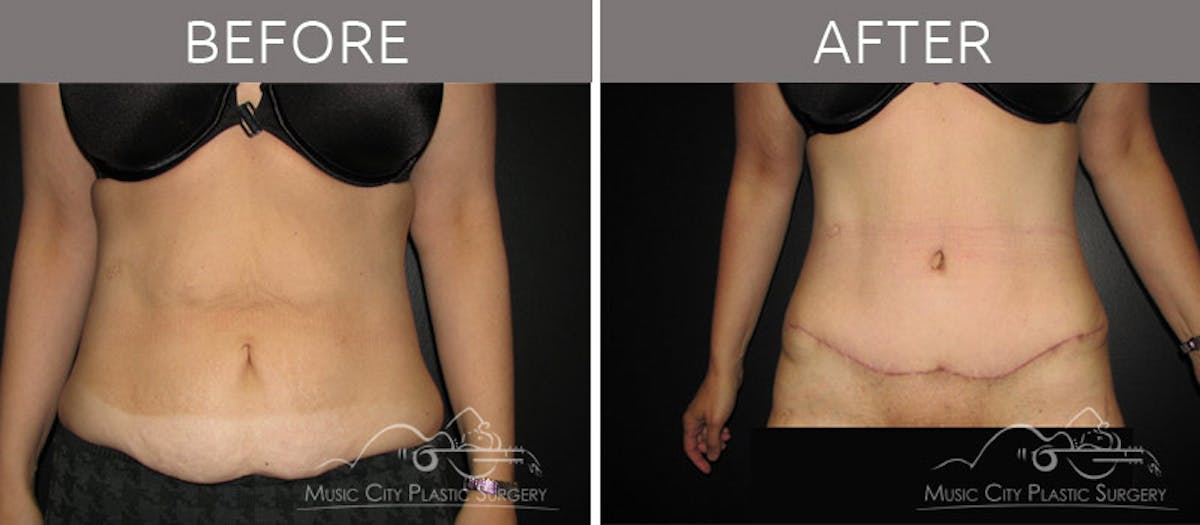 Abdominoplasty Before & After Gallery - Patient 90704928 - Image 1