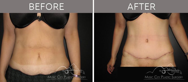 Abdominoplasty Before & After Gallery - Patient 90704928 - Image 1