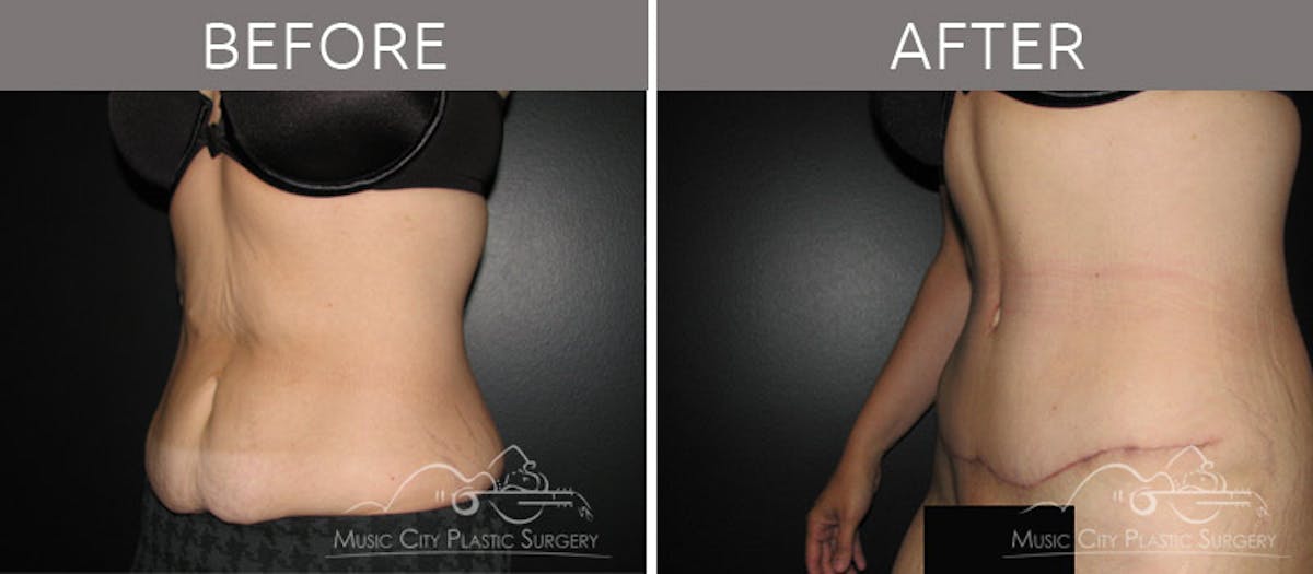 Abdominoplasty Before & After Gallery - Patient 90704928 - Image 2
