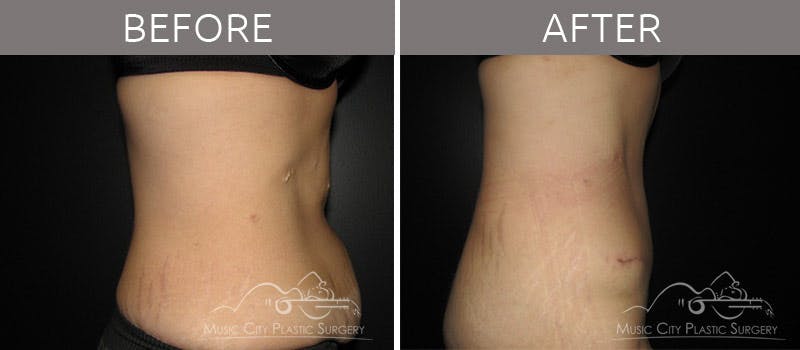 Abdominoplasty Before & After Gallery - Patient 90704928 - Image 3