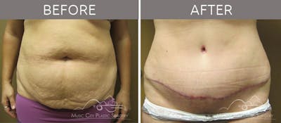 Abdominoplasty Before & After Gallery - Patient 90704940 - Image 1