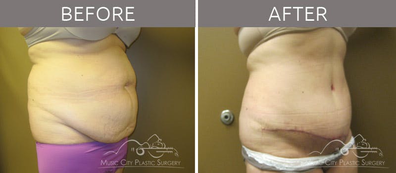 Abdominoplasty Before & After Gallery - Patient 90704940 - Image 2
