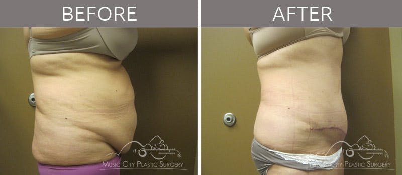Abdominoplasty Before & After Gallery - Patient 90704940 - Image 3