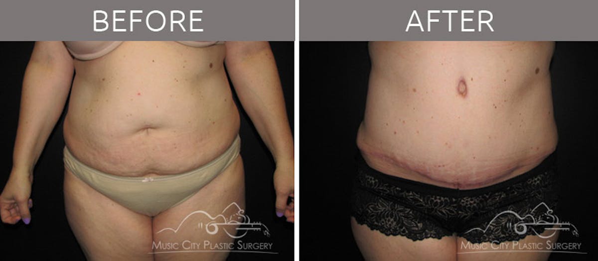 Abdominoplasty Before & After Gallery - Patient 90704941 - Image 1