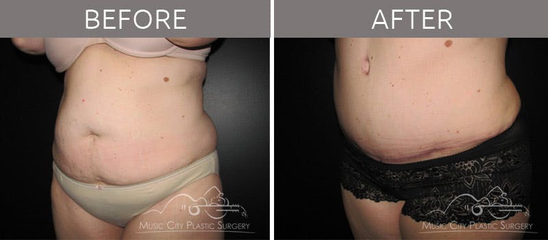 Abdominoplasty Before & After Gallery - Patient 90704941 - Image 2