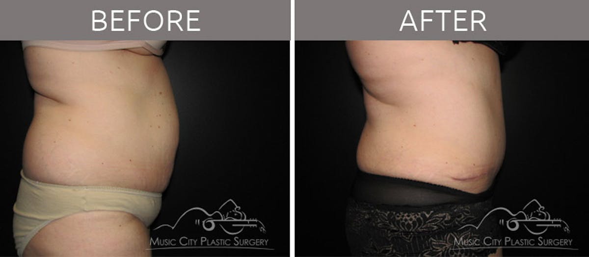 Abdominoplasty Before & After Gallery - Patient 90704941 - Image 3