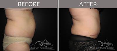 Abdominoplasty Before & After Gallery - Patient 90704941 - Image 3