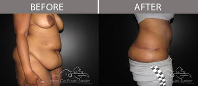 Body Lift Before & After Gallery - Patient 90704942 - Image 2