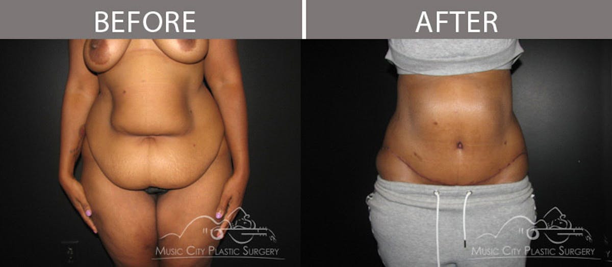 Body Lift Before & After Gallery - Patient 90704942 - Image 1