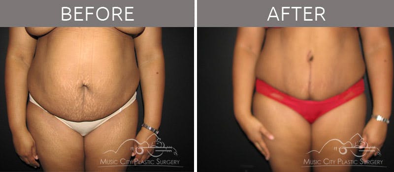 Abdominoplasty Before & After Gallery - Patient 90704949 - Image 1
