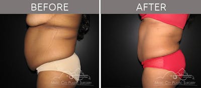 Abdominoplasty Before & After Gallery - Patient 90704949 - Image 3