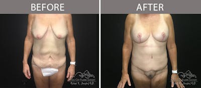 Bra Strap Excision Before & After Gallery - Patient 90704953 - Image 1