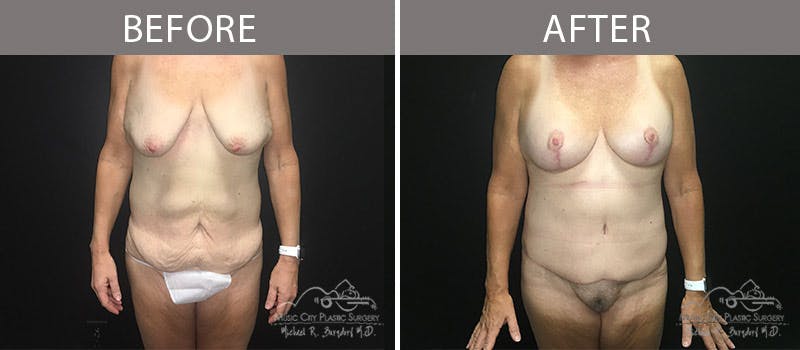 Bra Strap Excision Before & After Gallery - Patient 90704953 - Image 1